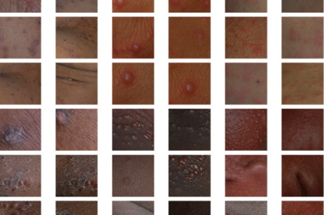 Immagini di malattie cutanee su diverse tonalità di pelle.